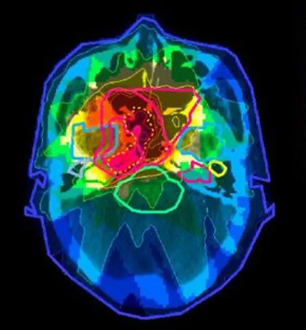 Beyin Kanserinde Radyasyon Tedavisinin Yan Etkileri Nelerdir?