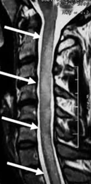 Nöromiyelitis optika nasıl tedavi edilir?