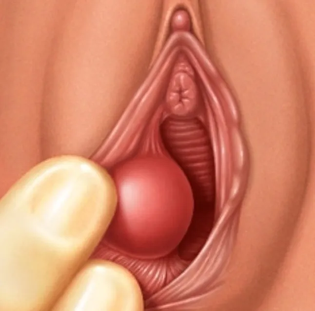 Bartholin Kisti ve Apsesi Nedir? Tedavisi Nasıl Yapılır?