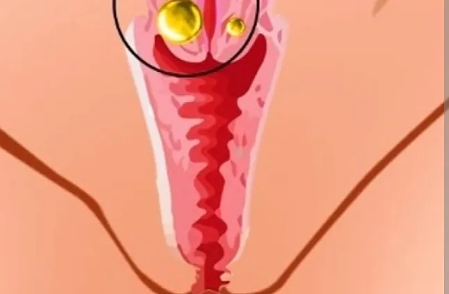 Bartholin Kisti ve Apsesi Nedir? Tedavisi Nasıl Yapılır?