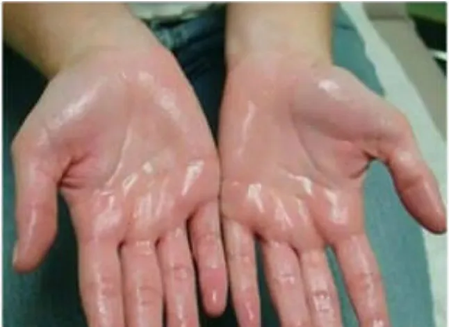 Aşırı terleme nedir? Nedenleri ve tedavileri nelerdir? Hyperhidrosis nedir?