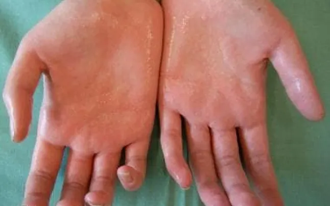 Aşırı terleme nedir? Nedenleri ve tedavileri nelerdir? Hyperhidrosis nedir?