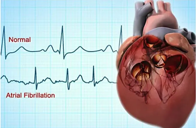 Atriyal Fibrilasyon Nedir? 
