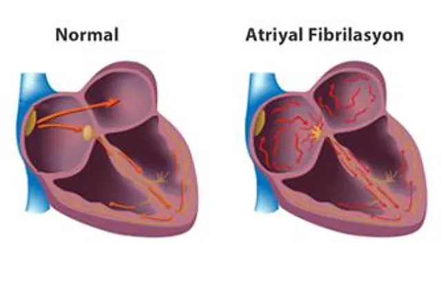 Atriyal Fibrilasyon Nedir? 