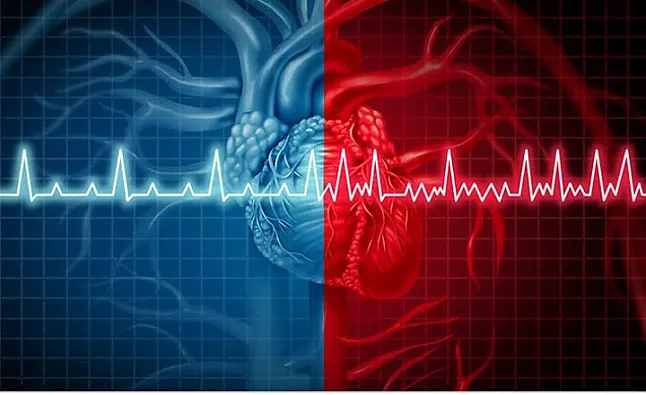 Atriyal Fibrilasyon Nedir? 