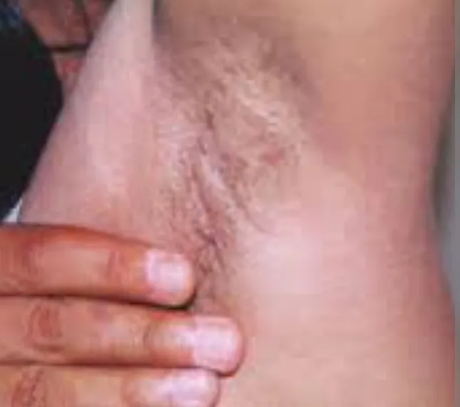 Akantozis Nigrikans (Acanthosis Nigricans) Nedir?