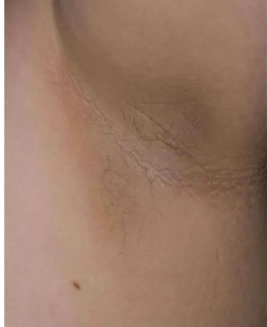 Akantozis Nigrikans (Acanthosis Nigricans) Nedir?