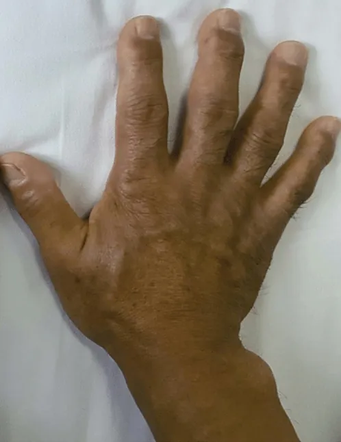 Akromegali Hastalığı Nedir? Akromegali Neden Olur? 