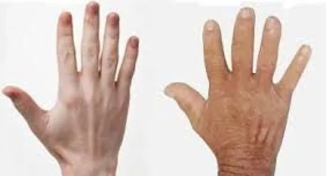 Akromegali Hastalığı Nedir? Akromegali Neden Olur? 